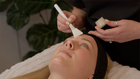 Chemical Peels