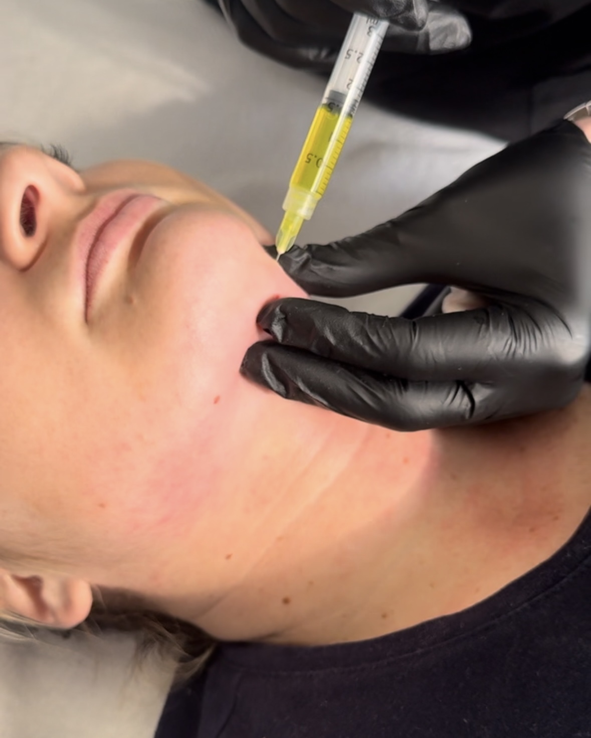 Liposolution