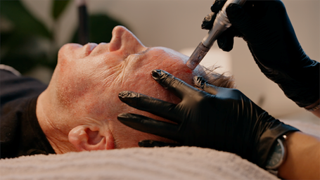 Microneedling 23