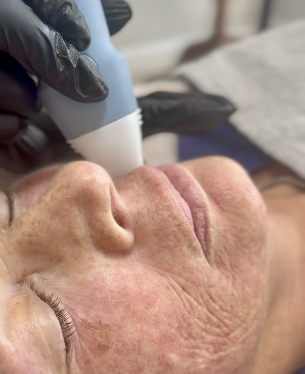 Microneedling